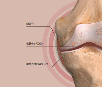 変形性膝関節症の症状と進行過程